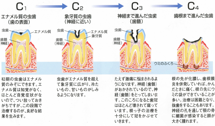 むし歯の進行。