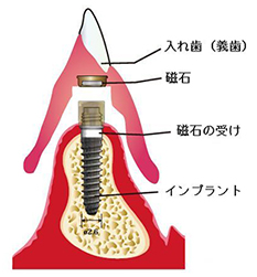 インプラント・マグネットデンチャー