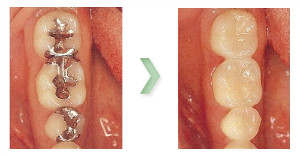 臼歯部（インレー）
