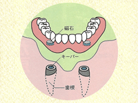 マグネットデンチャー