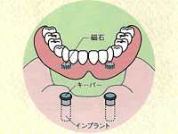 総入れ歯