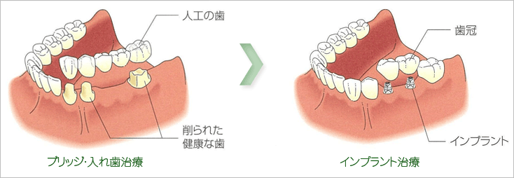 インプラント治療・隣接する歯を1、2本失った場合