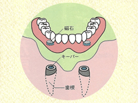 一人一人の患者様にぴったりな入れ歯治療を。