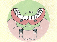 総入れ歯の場合