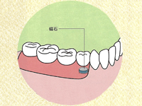 部分入れ歯の場合