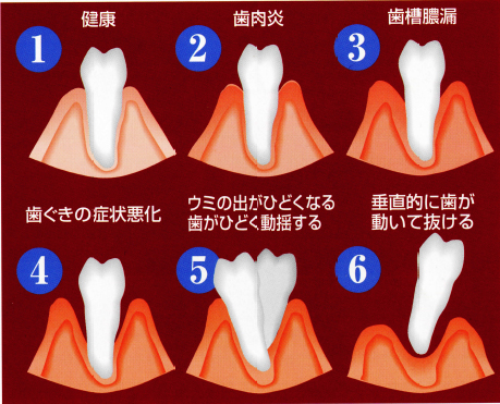 歯周病を放置すると最終的には歯が抜けてしまうこともあります。